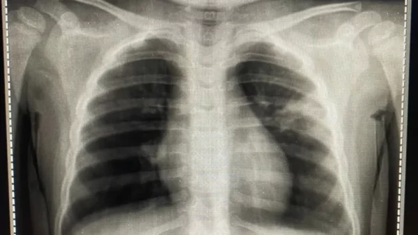 Así se ve la radiografía de un niño con posible covid-19