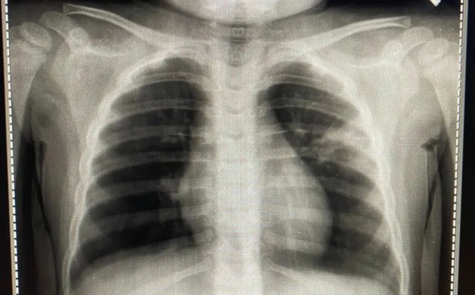 Así se ve la radiografía de un niño con posible covid-19