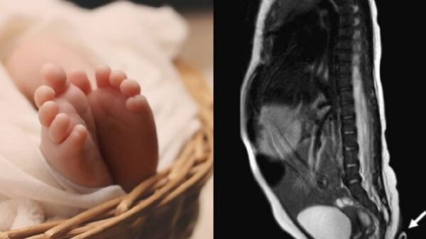 Nace bebé con cola de 5.7 centímetros en Nuevo León